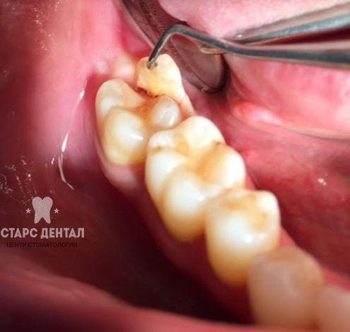 трещина в зубе до лечения