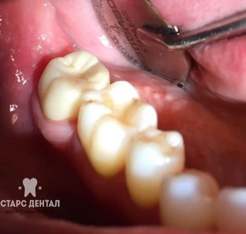 трещина в зубе до лечения