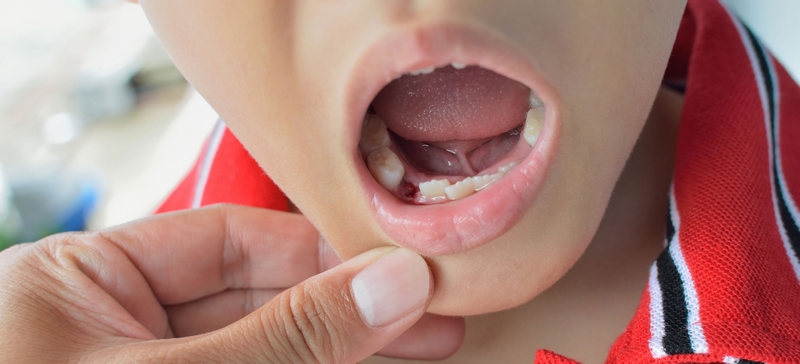 удаление зуба у детей